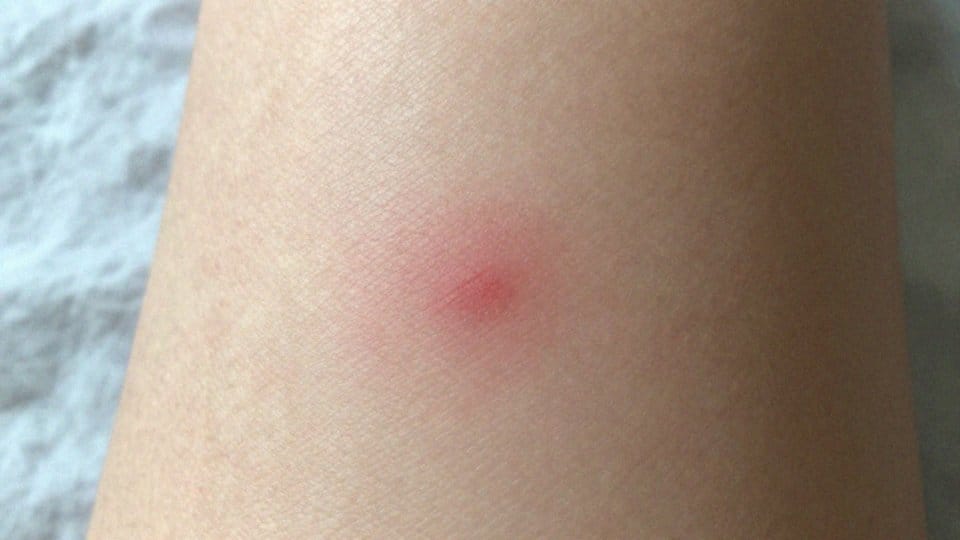 Jakie są objawy zakażenia Borrelia spielmanii?